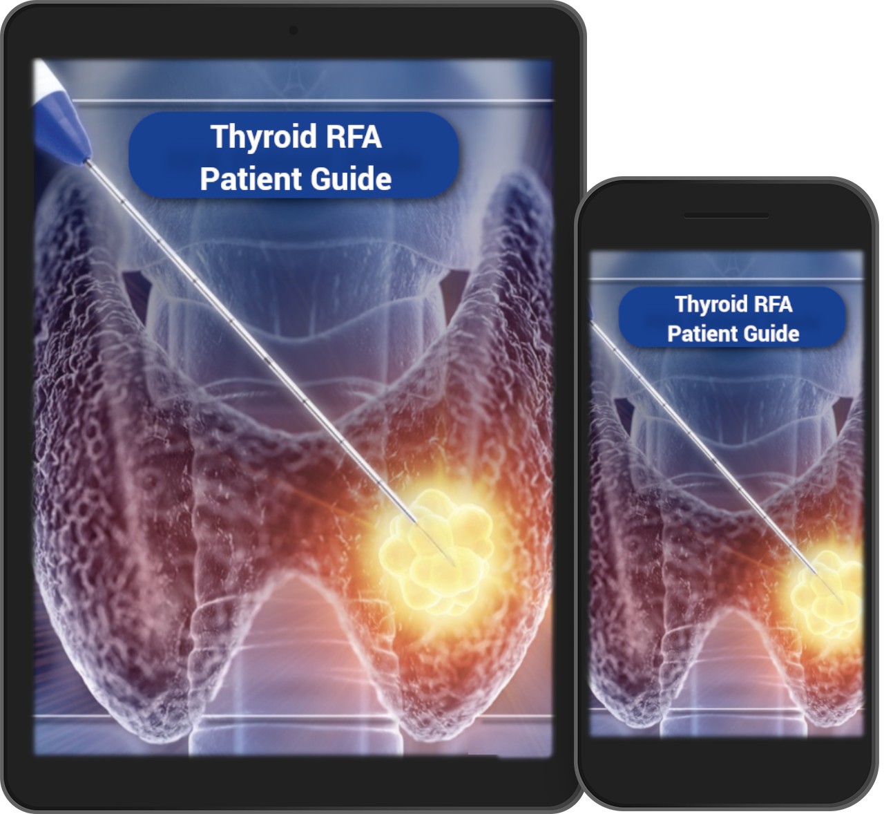 What Is Thyroid Rfa Quantum Thyroid